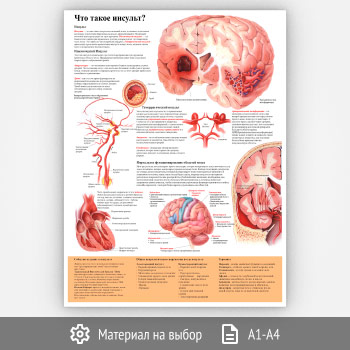 Плакат «Что такое инсульт» (ЗОЖ-13, 1 лист)